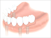 インプラントならすべての歯を補える