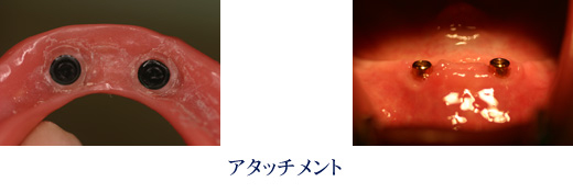 アタッチメント