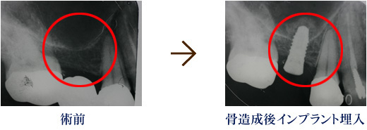 術前 骨造成後インプラント埋入