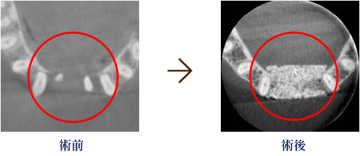 術前　骨造成後インプラント埋入