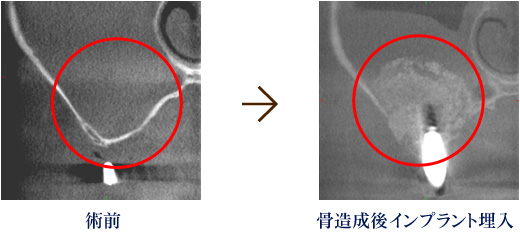 術前 骨造成後インプラント埋入