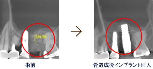 術前 骨造成後インプラント埋入