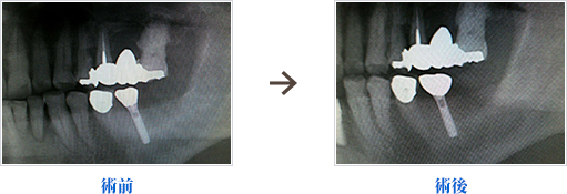 他院で入れたインプラントの補綴物を入れ替えた症例