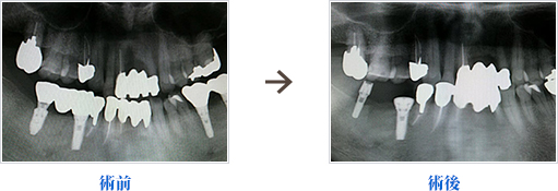 一番奥のインプラントの埋入方向が悪く、またインプラントが細いため入れ替えた症例