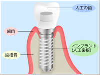 自分の歯を残すための人工歯根「インプラント」