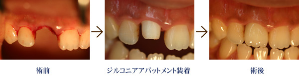 術前ジルコニアアバットメント装着術後