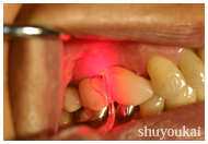 無熱ダイオードレーザー照射